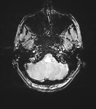 Cerebellar agenesis with hypoplastic pons (pontocerebellar hypoplasia) (Radiopaedia 57224-64138 Axial SWI 17).png