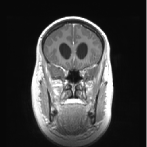 Cerebellar ependymoma complicated by post-operative subdural hematoma (Radiopaedia 83322-97736 Coronal T1 C+ 17).png