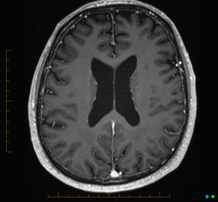 Cerebellar gangliocytoma (Radiopaedia 65377-74422 Axial T1 C+ 84).jpg