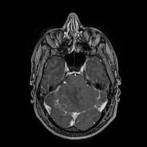 Cerebellar hemangioblastoma (Radiopaedia 88055-104622 Axial T1 C+ 65).jpg