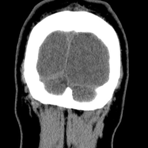 Cerebellar infarction (Radiopaedia 16625-16327 Coronal non-contrast 44).jpg