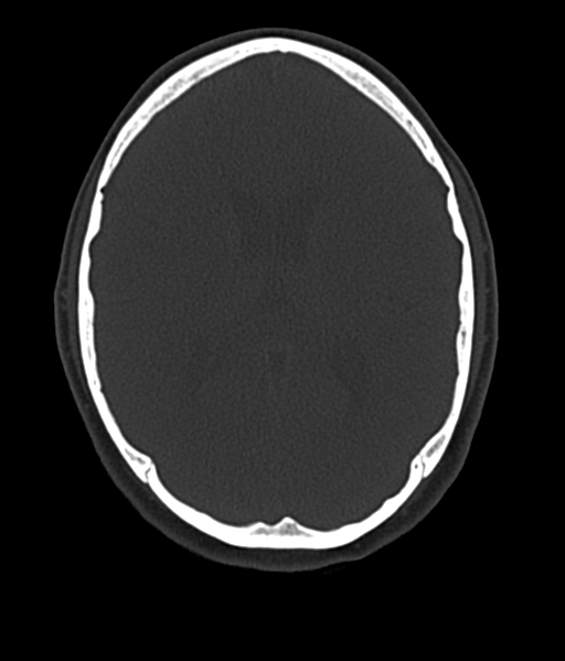 Cerebellar metastases - colorectal adenocarcinoma (Radiopaedia 40947-43652 AX Bone C- 2.0 MPR 35).png