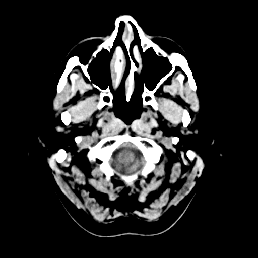 File:Cerebellar metastasis (Radiopaedia 54578-60812 Axial non-contrast 4).png