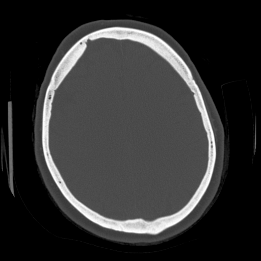 Cerebellar metastasis (cystic appearance) (Radiopaedia 41395-44258 Axial bone window 48).png
