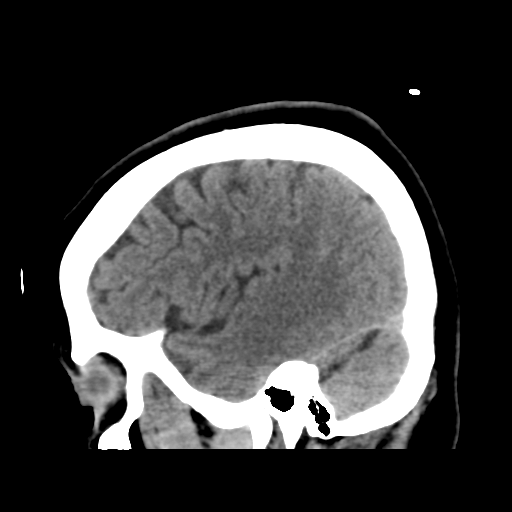 File:Cerebellar metastasis (cystic appearance) (Radiopaedia 41395-44258 E 16).png