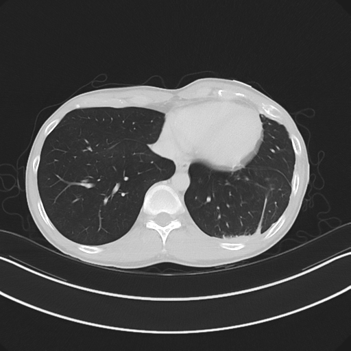 Cerebellar metastasis - adenocarcinoma lung (Radiopaedia 63184-71717 Axial lung window 52).png