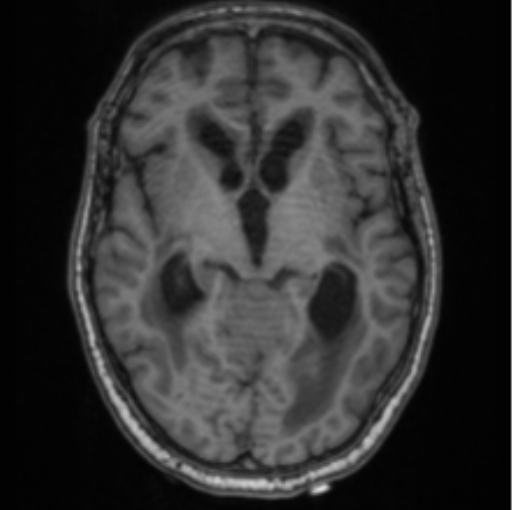 Cerebellar metastasis from lung adenocarcinoma (Radiopaedia 86690-102829 Axial T1 39).png