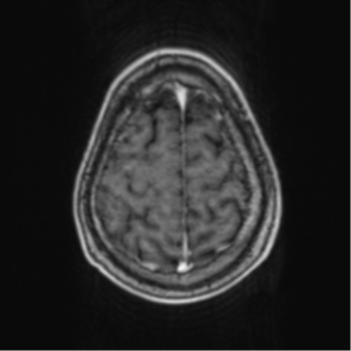 Cerebellar metastasis from lung adenocarcinoma (Radiopaedia 86690-102829 Axial T1 C+ 68).png