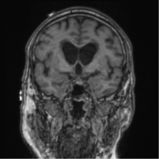 Cerebellar metastasis from lung adenocarcinoma (Radiopaedia 86690-102829 Coronal T1 61).png