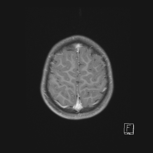 Cerebellar stroke (Radiopaedia 32202-33150 Axial T1 C+ 59).png