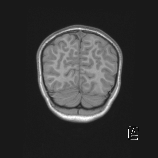 File:Cerebellar stroke (Radiopaedia 32202-33150 Coronal T1 52).png