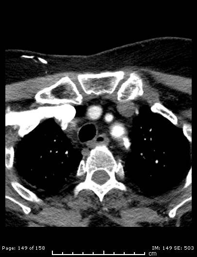 File:Cerebellar strokes due to intracranial giant cell arteritis (Radiopaedia 68799-78510 CT angiogram 149).jpg