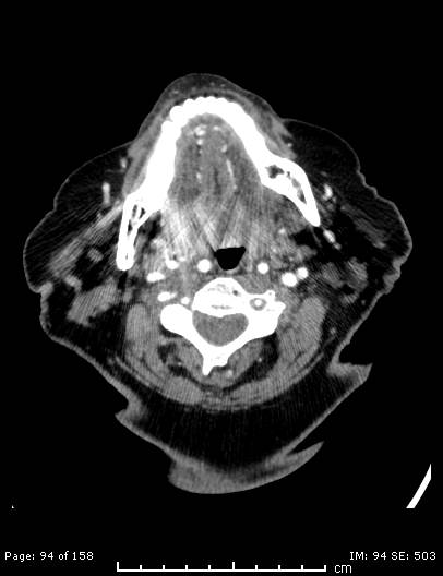 File:Cerebellar strokes due to intracranial giant cell arteritis (Radiopaedia 68799-78510 CT angiogram 94).jpg