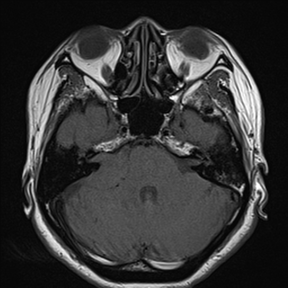 File:Cerebellopontine angle meningioma (Radiopaedia 53561-59591 Axial T1 12).jpg