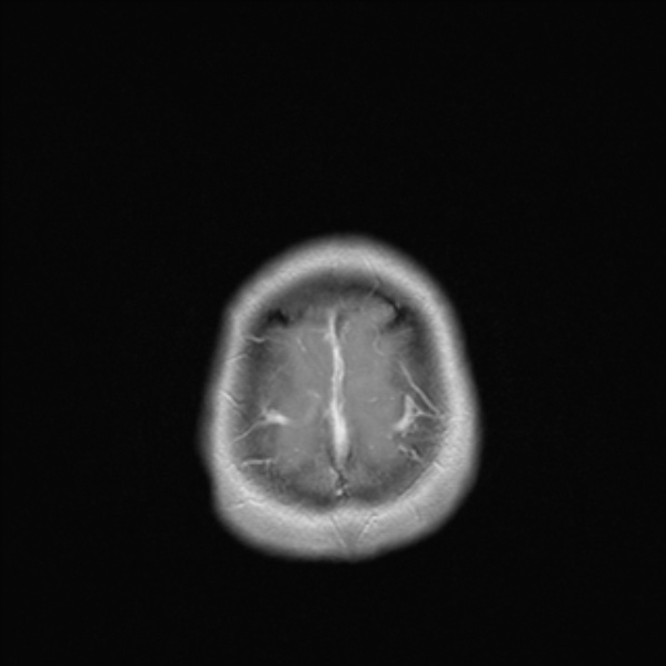 Cerebral abscess (Radiopaedia 24212-24478 Axial T1 C+ 54).jpg