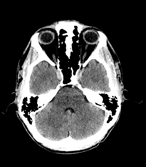 Cerebral abscess (Radiopaedia 57774-64741 Axial C+ delayed 24).png