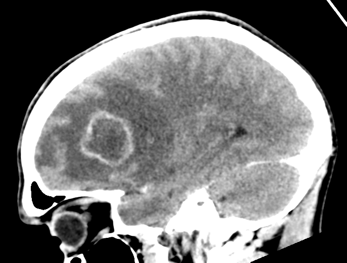 Cerebral abscess (Radiopaedia 60342-68008 Sagittal C+ delayed 35).png