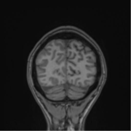 Cerebral abscess (Radiopaedia 60342-68009 Coronal T1 3).png