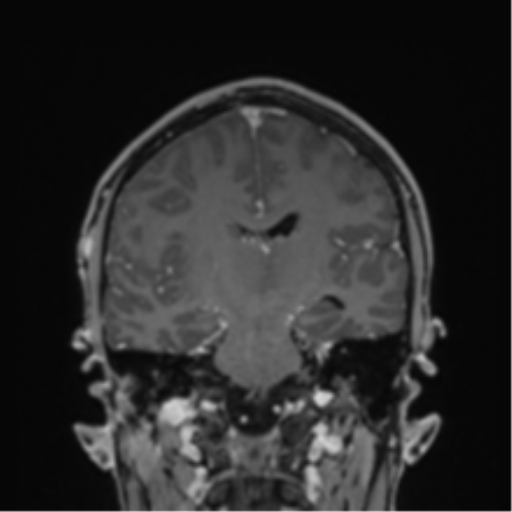 Cerebral abscess (Radiopaedia 60342-68009 H 22).png