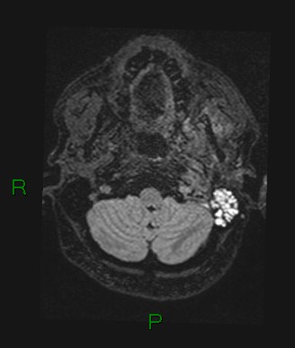 File:Cerebral abscess and subdural empyema (Radiopaedia 84436-99779 Axial FLAIR 74).jpg