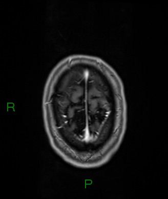 Cerebral abscess and subdural empyema (Radiopaedia 84436-99779 Axial T1 C+ 12).jpg