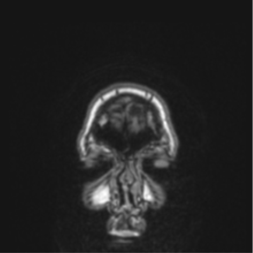 Cerebral abscess from pulmonary arteriovenous malformation (Radiopaedia 86275-102291 Coronal T1 86).png
