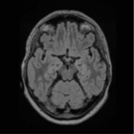 Cerebral abscess from pulmonary arteriovenous malformation (Radiopaedia 86275-102291 J 31).png