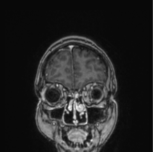 Cerebral abscess from pulmonary arteriovenous malformation (Radiopaedia 86275-102291 L 76).png
