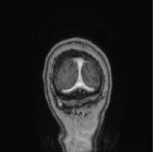 File:Cerebral abscess from pulmonary arteriovenous malformation (Radiopaedia 86275-102291 L 9).png