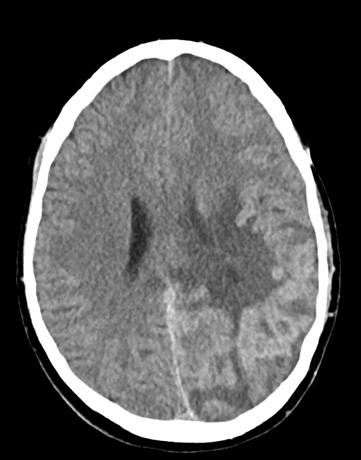 Cerebral abscesses (Radiopaedia 70458-80568 Axial non-contrast 39).jpg