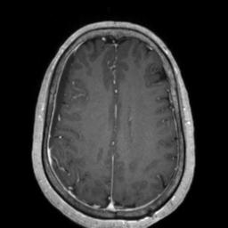 File:Cerebral amyloid angiopathy (Radiopaedia 29129-29518 Axial T1 C+ 100).jpg