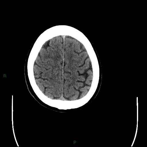 Cerebral amyloid angiopathy (Radiopaedia 77506-89665 Axial non-contrast 91).jpg