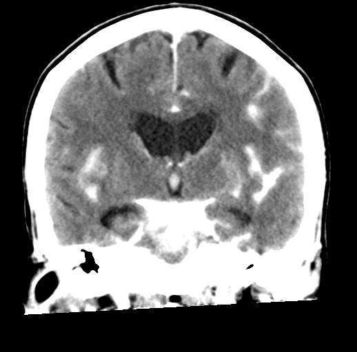 File:Cerebral aneurysm with rupture (Radiopaedia 29933-30460 Coronal non-contrast 18).jpg