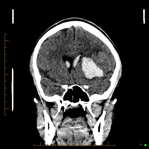 Cerebral arteriovenous malformation (AVM) (Radiopaedia 78162-90706 Coronal non-contrast 38).jpg