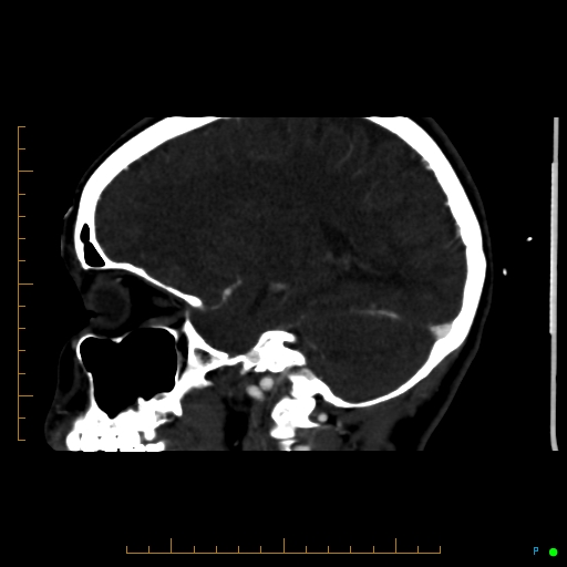 Cerebral arteriovenous malformation (AVM) (Radiopaedia 78162-90706 Sagittal CTA 52).jpg