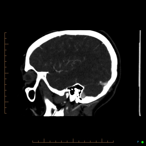 Cerebral arteriovenous malformation (AVM) (Radiopaedia 78162-90706 Sagittal CTA 61).jpg