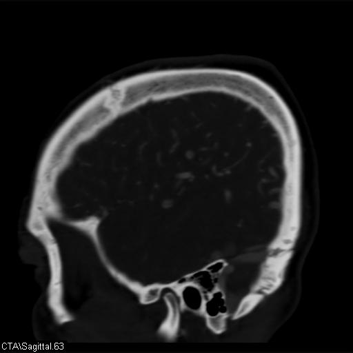 Cerebral arteriovenous malformation (Radiopaedia 28518-28759 D 60).jpg