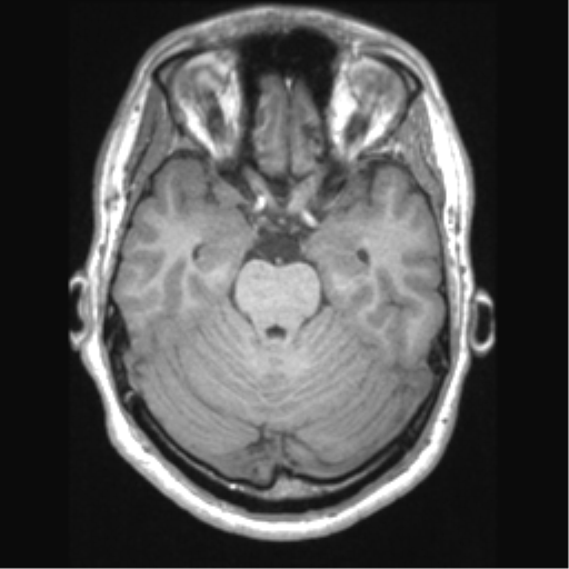 File:Cerebral arteriovenous malformation (Radiopaedia 39259-41506 Axial T1 27).png