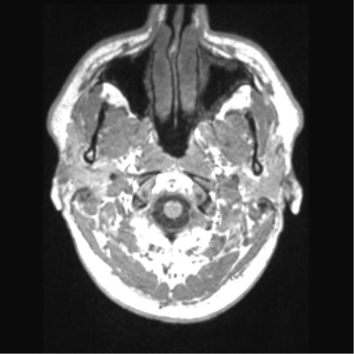 Cerebral arteriovenous malformation (Radiopaedia 39259-41506 Axial T1 5).png
