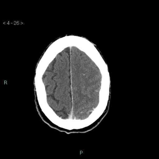 File:Cerebral arteriovenous malformation (Radiopaedia 40528-43125 Axial C+ delayed 26).jpg