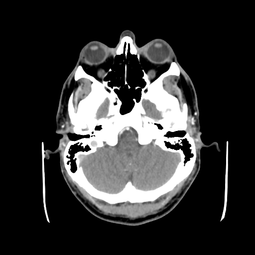 Cerebral arteriovenous malformation (Radiopaedia 55798-62371 B 10).png