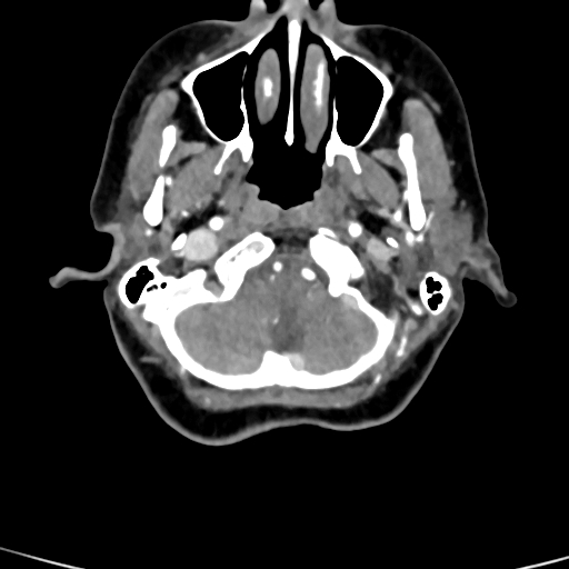 File:Cerebral arteriovenous malformation (Radiopaedia 73830-84645 B 90).jpg