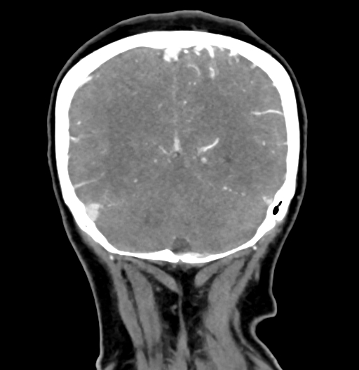 Cerebral arteriovenous malformation (Radiopaedia 73830-84645 C 77).jpg