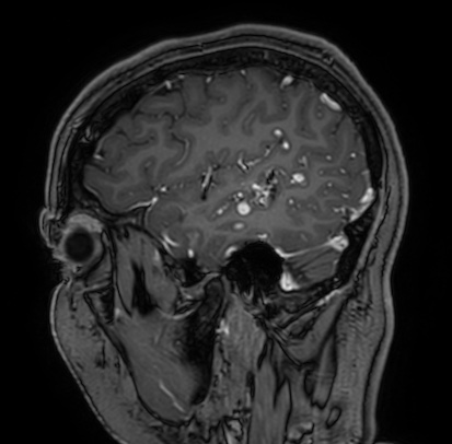 Cerebral arteriovenous malformation (Radiopaedia 74411-85654 Sagittal T1 C+ 21).jpg