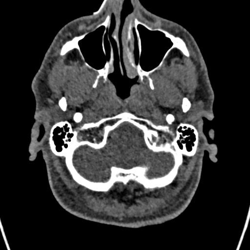 File:Cerebral arteriovenous malformation (Radiopaedia 78188-90746 Axial non-contrast 19).jpg