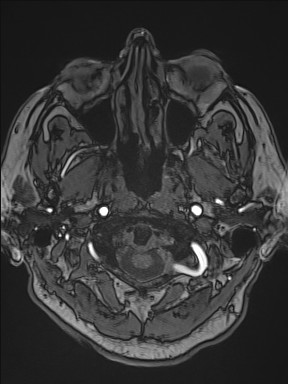 Cerebral arteriovenous malformation (Radiopaedia 84015-99245 Axial TOF 40).jpg