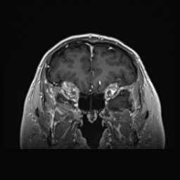 Cerebral arteriovenous malformation (Radiopaedia 84015-99245 Coronal T1 C+ 41).jpg