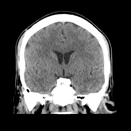 File:Cerebral arteriovenous malformation (Spetzler-Martin grade 2) (Radiopaedia 41262-44076 Coronal non-contrast 28).png