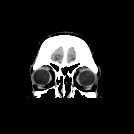 File:Cerebral arteriovenous malformation (Spetzler-Martin grade 2) (Radiopaedia 41262-44076 Coronal non-contrast 6).png