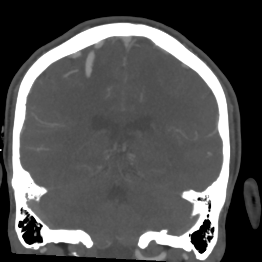 Cerebral arteriovenous malformation (Spetzler-Martin grade 2) (Radiopaedia 41262-44076 F 42).png